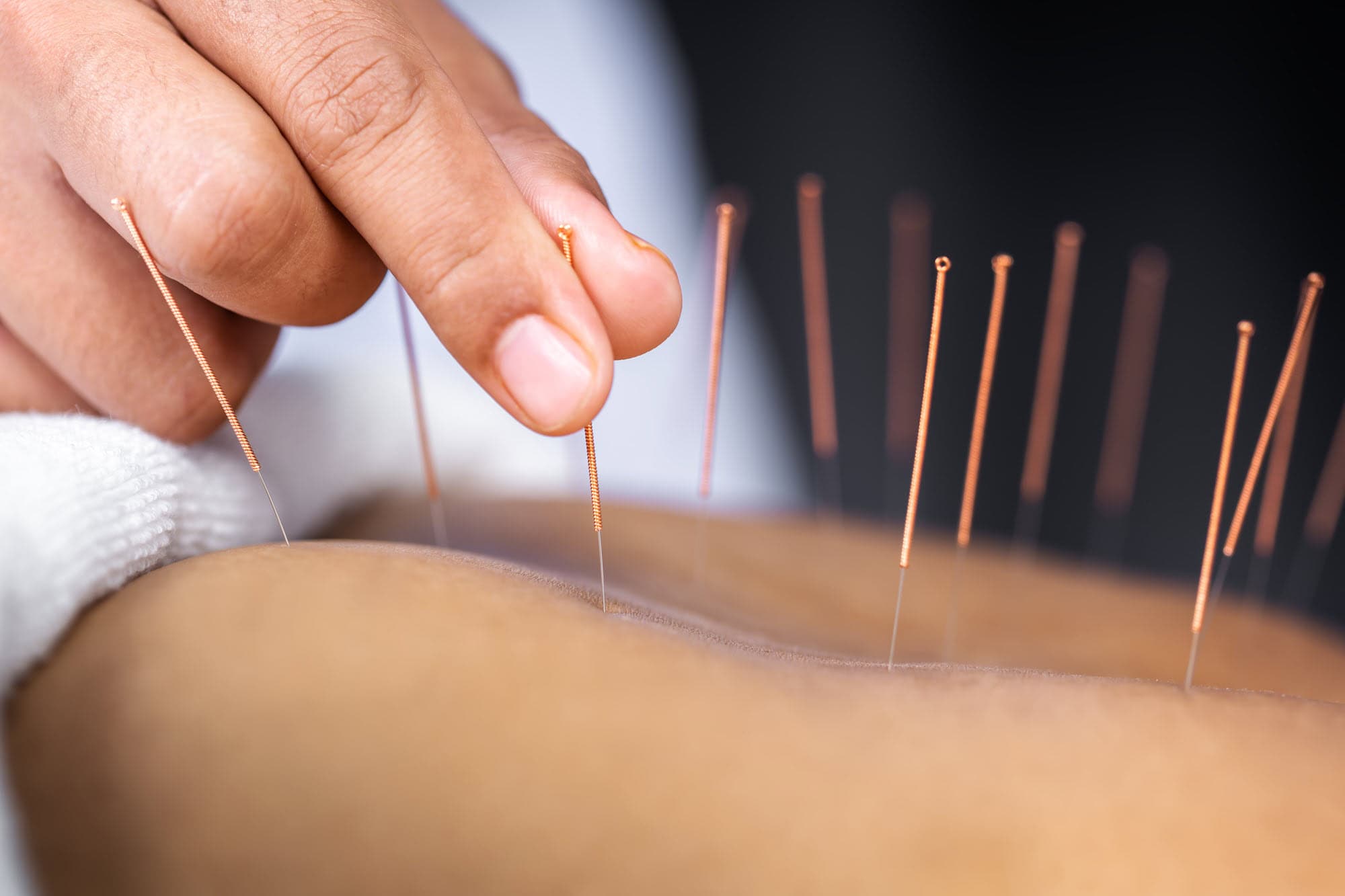 Acupuncture in Kearney